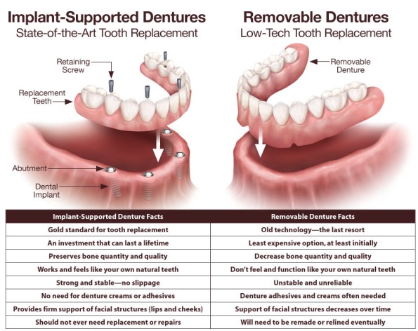 https://edgewater-dentist.com/wp-content/uploads/2021/11/All-On-4-Implant-Dentures-1.jpg