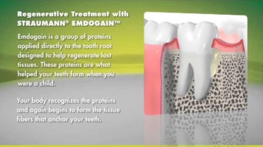 https://edgewater-dentist.com/wp-content/uploads/2021/11/Emdogain-1.jpg