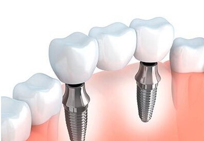 https://edgewater-dentist.com/wp-content/uploads/2021/11/Implant-Bridge-1.jpg