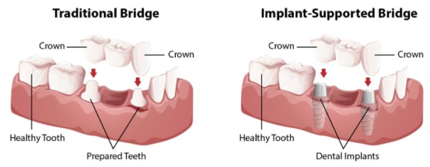 https://edgewater-dentist.com/wp-content/uploads/2021/11/Implant-Bridge-2.jpg