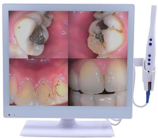 https://edgewater-dentist.com/wp-content/uploads/2021/11/Intra-Oral-Camera-2.jpg