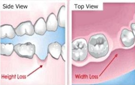 https://edgewater-dentist.com/wp-content/uploads/2021/11/Ridge-Augmentation-1.jpg