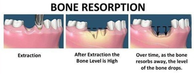 https://edgewater-dentist.com/wp-content/uploads/2021/11/Ridge-Augmentation-2.jpg