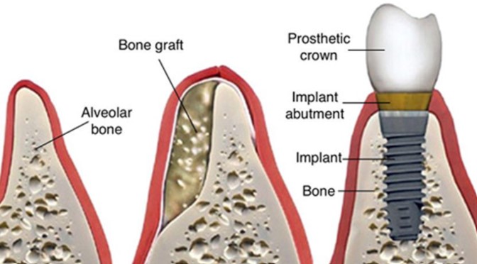 https://edgewater-dentist.com/wp-content/uploads/2021/11/Ridge-Augmentation-4.jpg