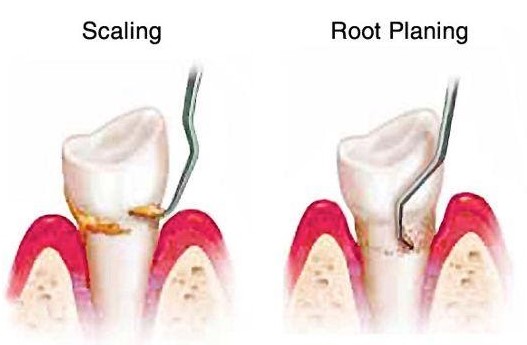 https://edgewater-dentist.com/wp-content/uploads/2021/11/SRP-2.jpg