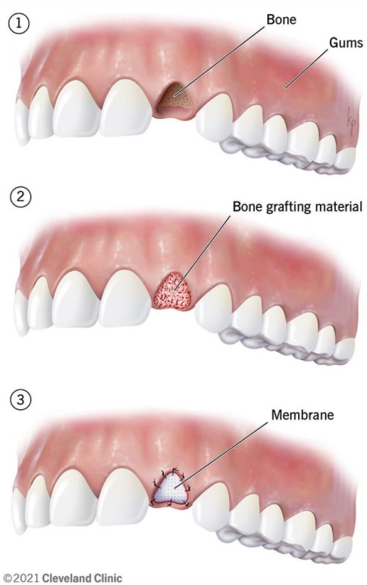 https://edgewater-dentist.com/wp-content/uploads/2021/11/Socket-Preservation-1.jpg