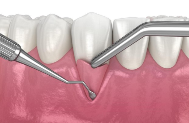 https://edgewater-dentist.com/wp-content/uploads/2021/11/Tissue-Graft-1.jpg