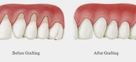 https://edgewater-dentist.com/wp-content/uploads/2021/11/Tissue-Graft-2.jpg