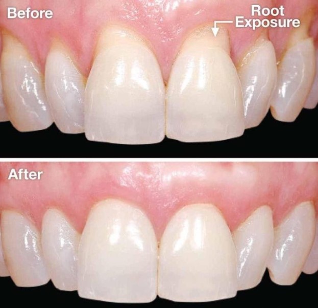 https://edgewater-dentist.com/wp-content/uploads/2021/11/Tissue-Graft-3.jpg