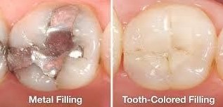 https://edgewater-dentist.com/wp-content/uploads/2021/12/Fillings-2.jpg