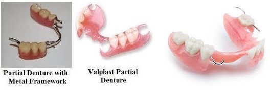 https://edgewater-dentist.com/wp-content/uploads/2021/12/Partial-Dentures-1.jpg