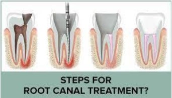 https://edgewater-dentist.com/wp-content/uploads/2021/12/Root-Canal-Treatment-1.jpg