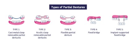 https://edgewater-dentist.com/wp-content/uploads/2021/12/partial-dentures-2.jpg